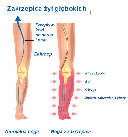 zakrzepica w podróży