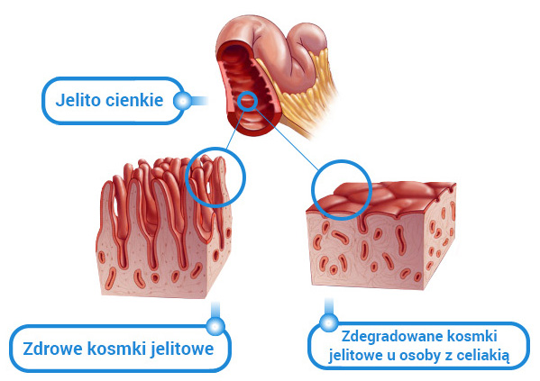 ból brzucha, przyczyny bólu brzucha, ból brzucha przyczyny, celiakia ból brzucha