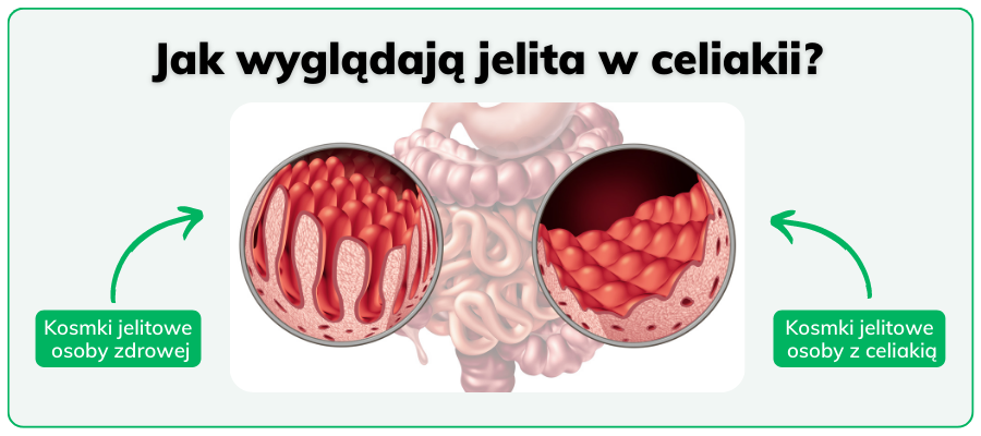 Grafika przedstawiająca kosmki jelitowe osoby zdrowej i osoby z celiakią
