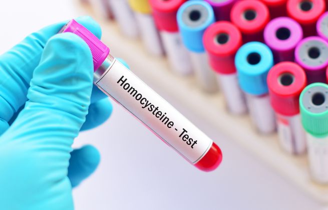 czy bać się homocysteiny