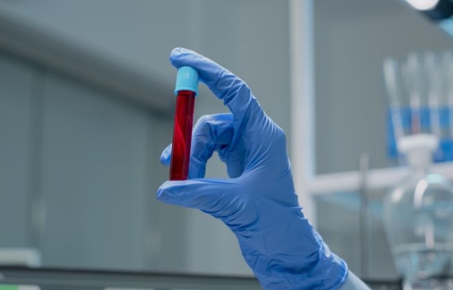 Hemochromatoza - jak się objawa choroba