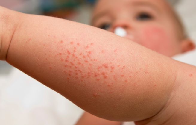 Wysypka alergiczna u dziecka - skąd się bierze
