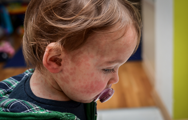 Czym leczyc alergie u dziecka