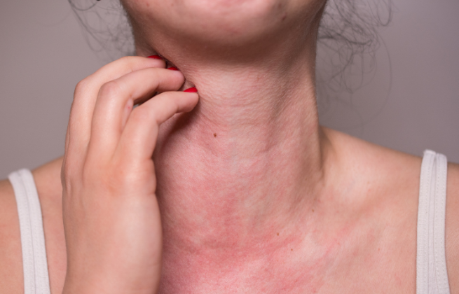 Jakie sa rodzaje alergii