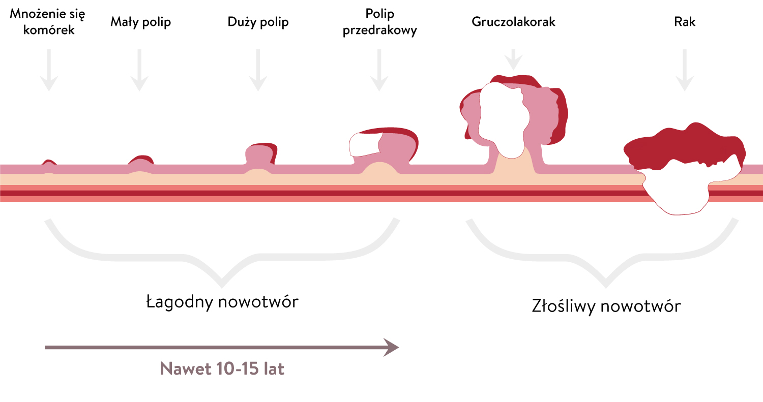 Stadia-rozwoju-raka-jelita-grubego.